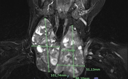 Tức ngực, khó thở vì bướu giáp to khổng lồ 10cm hiếm gặp