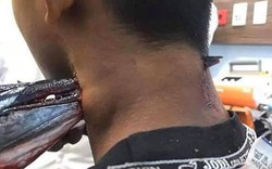 Indonesia: Đang câu cá, bị cá nhái phi thân khỏi mặt nước đâm xuyên cổ