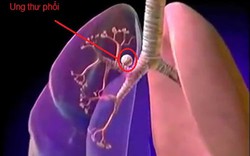 Hút thuốc lá có thể bị 8 bệnh ung thư