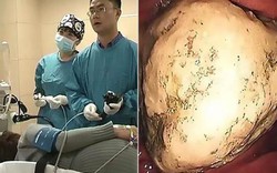 Sỏi 5 cm “án ngữ” trong bụng, bệnh nhân sốc khi biết cách nó được tạo thành