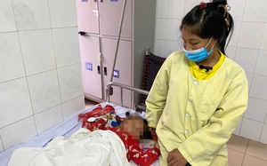 Bé gái ở Bắc Kạn bị bỏng nặng bố mẹ không có tiền chuyển viện