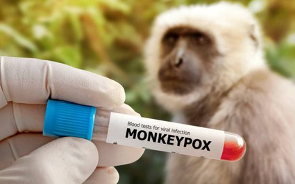 Bệnh nhân đầu tiên mắc bệnh đậu mùa khỉ tại Việt Nam là ai? 