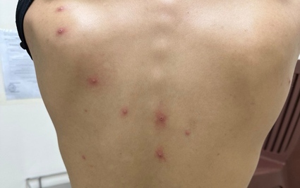 TP.HCM phát hiện ca đậu mùa khỉ thứ 5