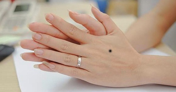 Nốt ruồi hình tam giác ở bàn tay là gì?
