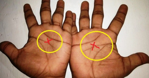 Lòng bàn tay có hình tròn là điều gì?
