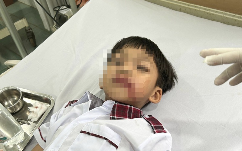 Đắk Nông: Kinh hoàng học sinh bị chó lạ tấn công, một bé trai bị rách cả mặt